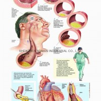 ATHEROSCLEROSIS--3D RELIEF WALL MEDICAL/PHARMA CHART/POSTER