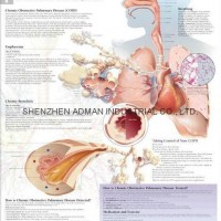 COPD（CHRONIC OBSTRUCTIVE PULMONARY DISEASE--3D RELIEF WALL MEDICAL/PHARMA POSTER