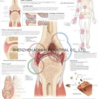 UNDERSTANDING ARTHRITIS--3D RELIEF WALL MEDICAL/PHARMA CHART/POSTER