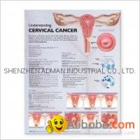 CERVICAL CANCER--3D RELIEF WALL MEDICAL/PHARMA CHART/POSTER