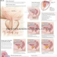 UNDERSTANDING PROSTATE CANCER--3D RELIEF WALL MEDICAL/PHARMA CHART/POSTER