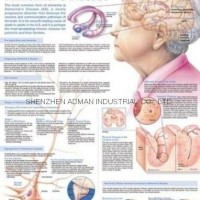 ALZHEIMER'S DISEASE--3D RELIEF WALL MEDICAL/PHARMA CHART/POSTER