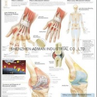 RHEUMATOID ARTHRITIS--3D RELIEF WALL MEDICAL/PHARMA CHART/POSTER