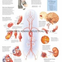 UNDERSTANDING HYPERTENSION--3D RELIEF WALL MEDICAL/PHARMA CHART/POSTER